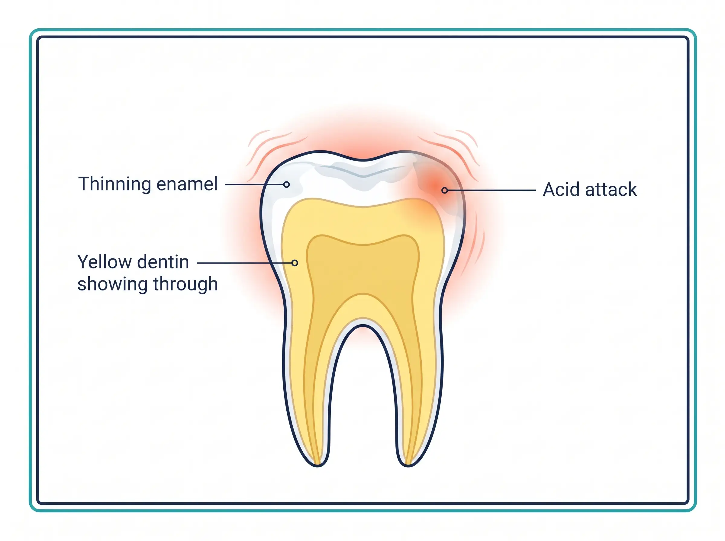 Labeled diagram: thinning enamel, yellow dentin showing through, acid attack